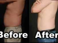 No Incisions, No Needles