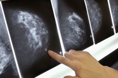 New Breast Cancer Recommendation Baffles Women