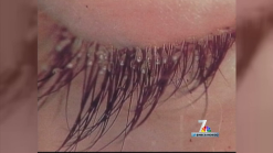 Report of Lice Concerns Teachers, Parents