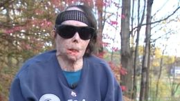 Latest Face Transplant