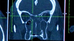 A Sinus Solution