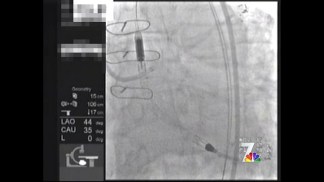 New Device Helps 'Inoperable' Patients