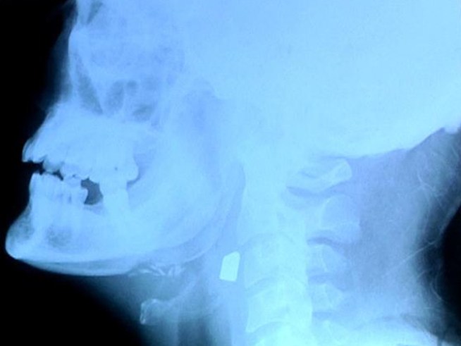 One of the bullets is still lodged in his neck.