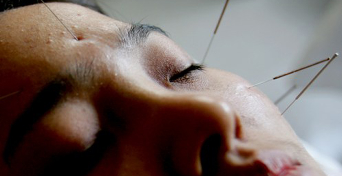 acupuncture