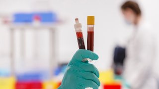 An employee shows a blood sample for COVID-19 antibody testing at the Labor Dr. Heidrich & Kollegen MVZ GmbH medical lab, April 16, 2020, in Hamburg, Germany.