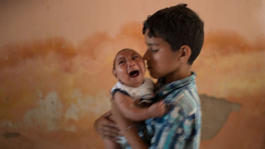 Brazil Zika Birth Defects