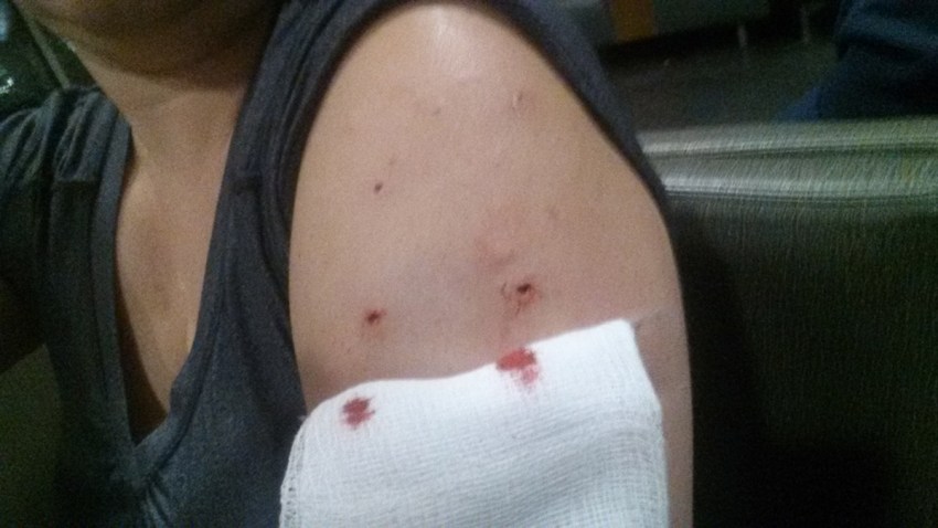 Bobcat injuries