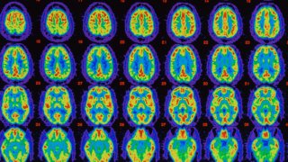 Positron Emission Tomography (PET) is used in the diagnosis and treatment of brain diseases. The red colour shows maximum, healthy blood flow, the yellow-green indicates less blood flow whilst dark green and purple-blue areas indicate no flow.