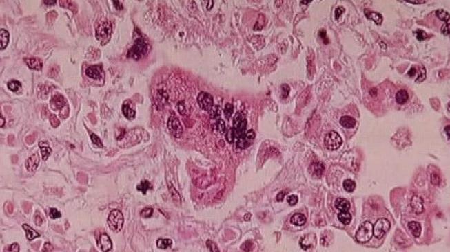Measles_Generic_722x406_19018080101