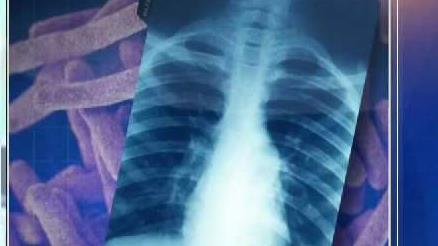Health Officials Working to Notify MTS Riders After Passenger Tests Positive for Tuberculosis - Vimarsana News
