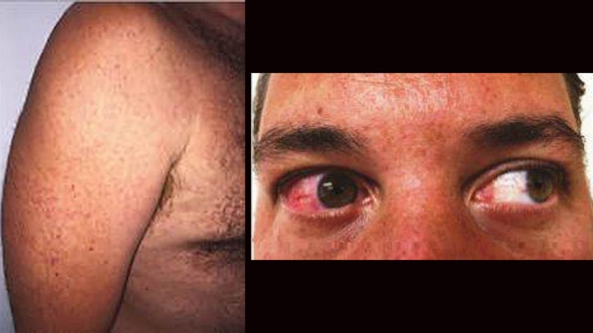Zika Infection Puerto Rico Patient