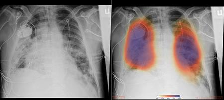 covid 19 pneumonia lung health xray ray chest ai using diego san ucsd uc imaging rays coronavirus analysis patient helping