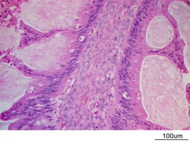 ovarian cancer