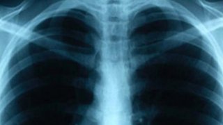 Radiografía de pulmones