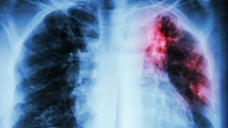 tuberculosis-foto-thumbnail