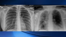 An X-ray of the lungs of a vaccinated COVID-19 patient (left) and an unvaccinated COVID-19 patient.