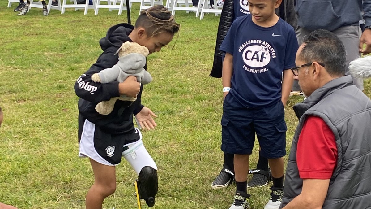 10-Year-Old Amputee from Chula Vista Celebrates Getting New Prosthetic Running Leg - Vimarsana News
