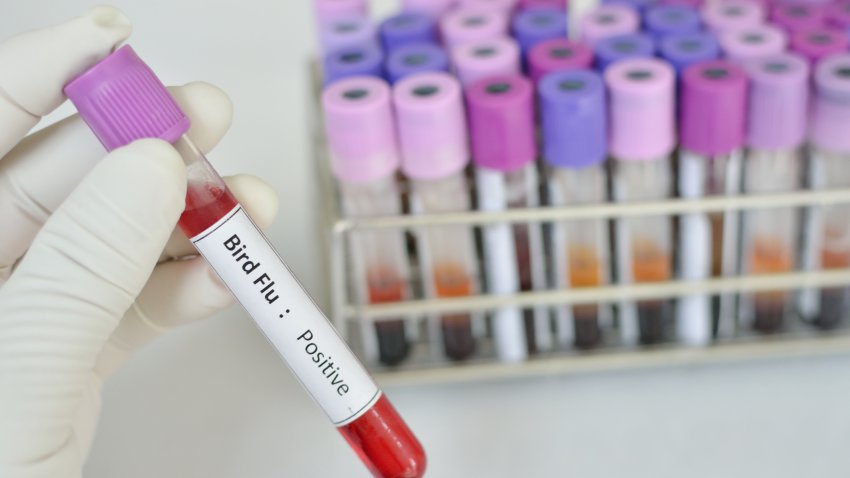 FILE a blood sample identified with bird flu.