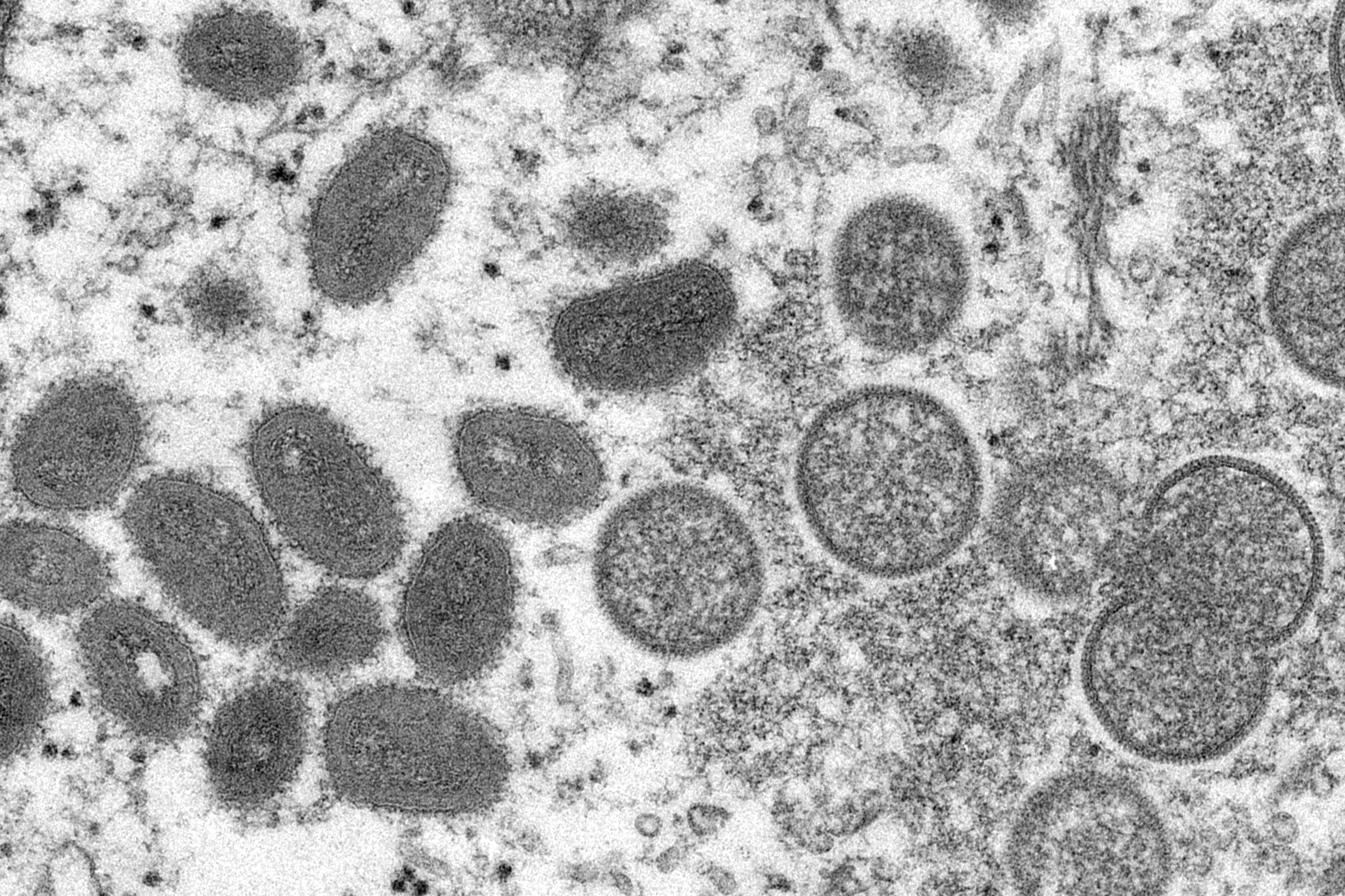 Israel Reports First Case of Monkeypox, Suspects Others – NBC 7 San Diego