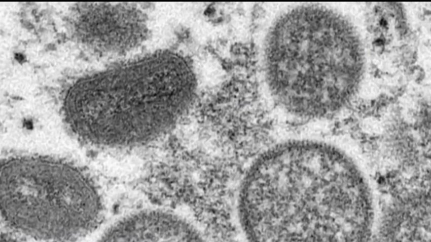 Probable Cases of Monkeypox Found in San Diego