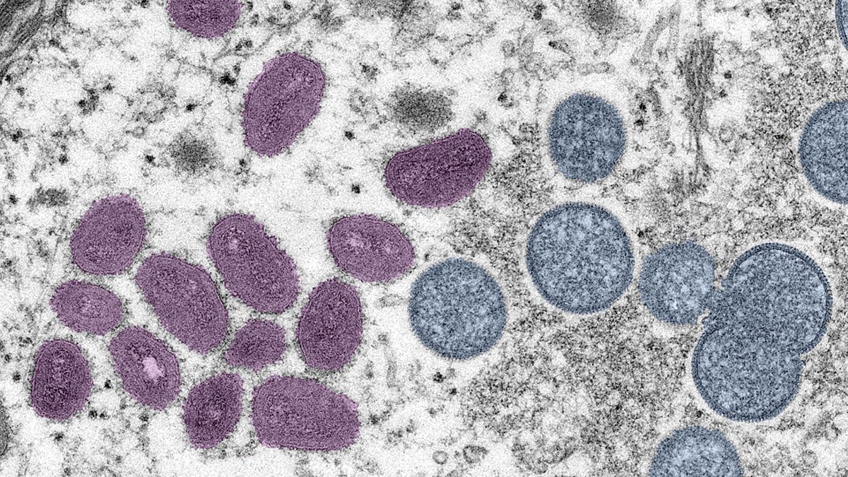 Monkeypox Treatment Being Tested by UC San Diego – NBC 7 San Diego - Vimarsana News