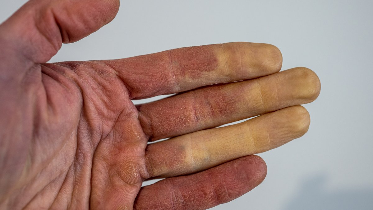 What Is Raynaud's Disease? – NBC 7 San Diego - Vimarsana News