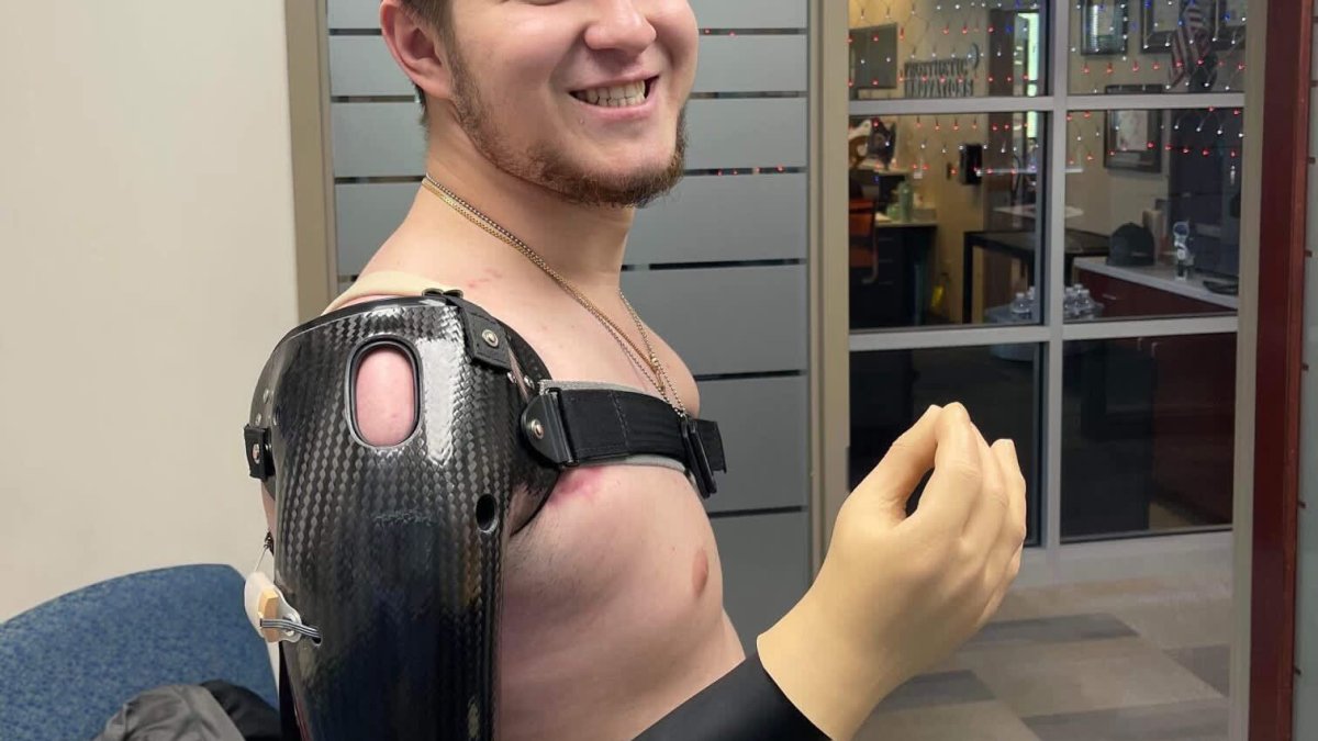'I Really Want to Go Back to Fight:' A Wounded Ukrainian Soldier Reflects on His Recovery – NBC 7 San Diego - Vimarsana News