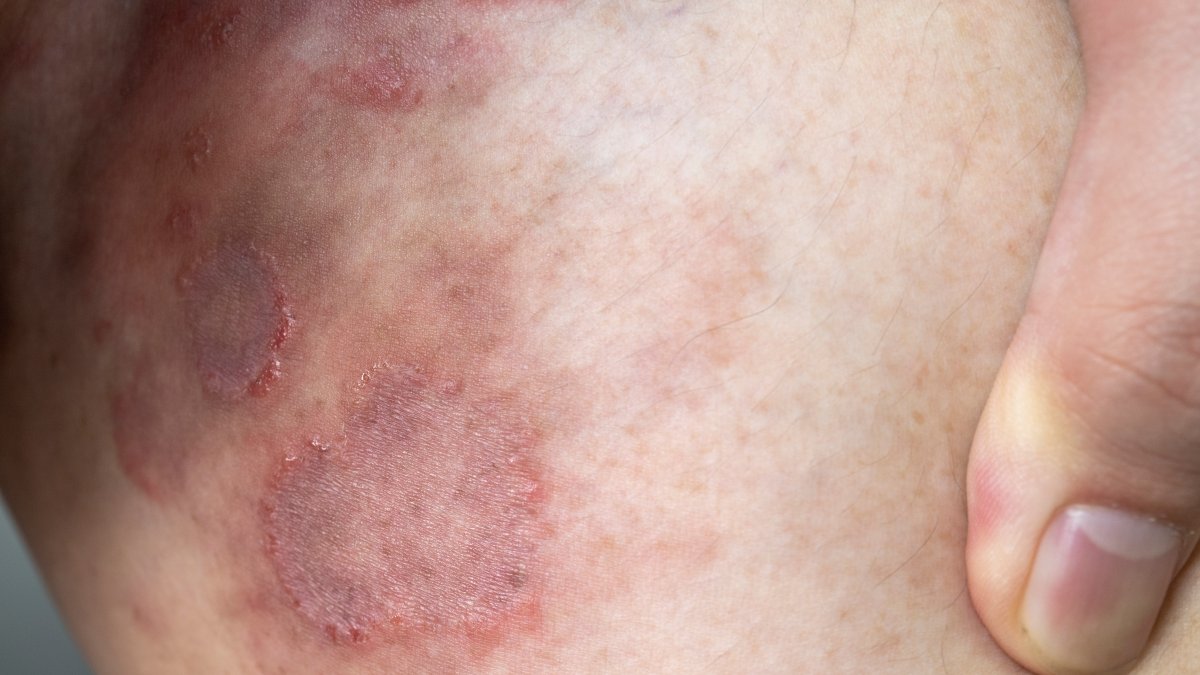 First Resistant Ringworm Infections Detected in United States – NBC 7 San Diego - Vimarsana News