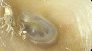 A 64-year-old woman in Taiwan sought treatment for a spider in her ear.