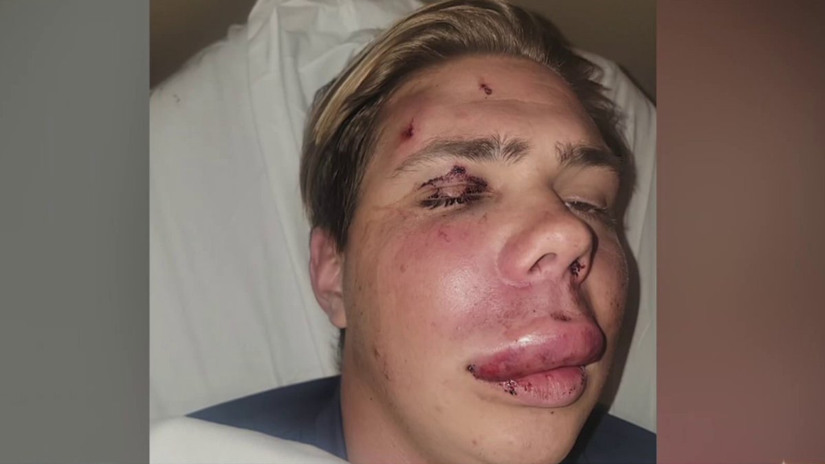 'I didn't expect to have my face broken': San Diego trolley attack victim shares story – NBC 7 San Diego - Vimarsana News