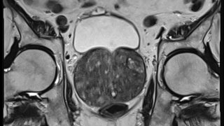 Benign Prostatic Hyperplasia (BPH)