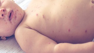 File image: A child with measles.