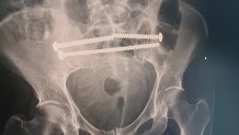 X-ray of Debra Brennan's hip injuries