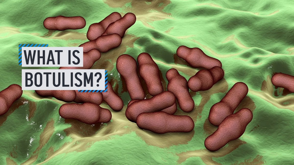 What is botulism? – NBC 7 San Diego