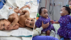 Surgeons in Philadelphia successfully separate conjoined twin boys