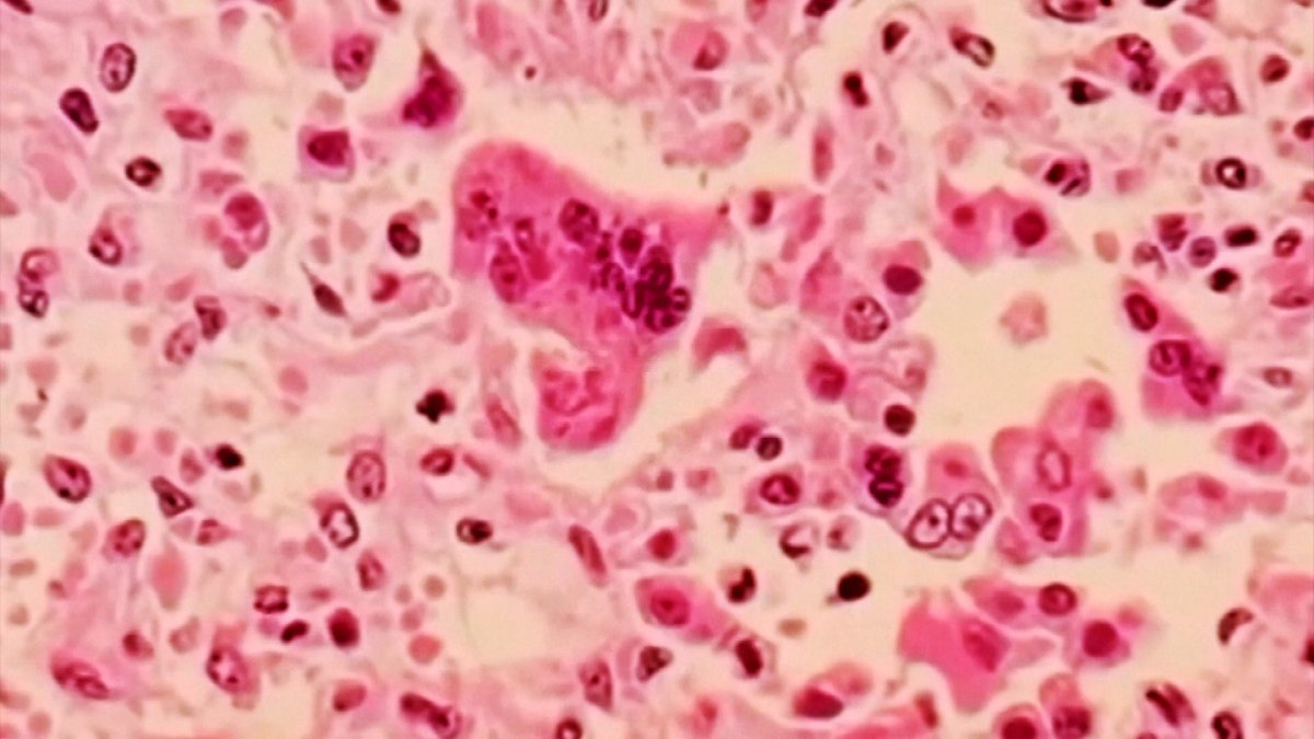 CDC urging travelers to be vaccinated against measles