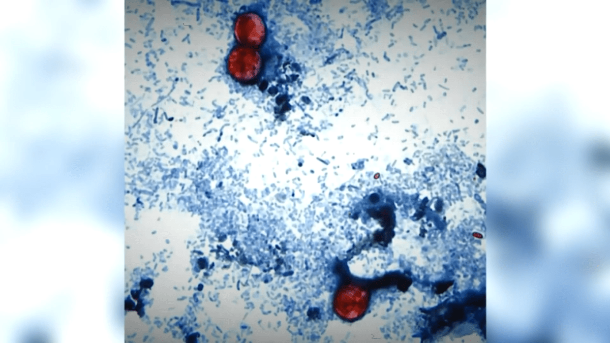 Officials urge caution even as California cyclosporiasis cases not linked to outbreak