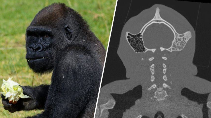 Minzani post surgery (left) next to a scan of his head during surgery.