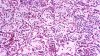 What to know about pneumonic plague after woman in Russia dies from mysterious illness